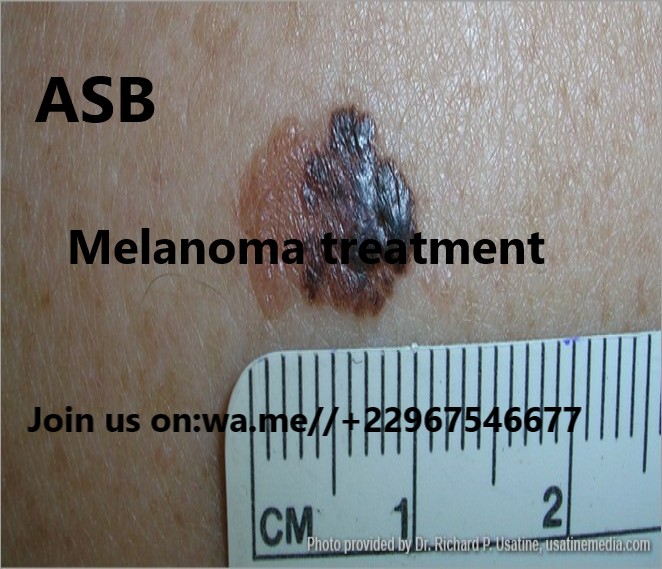 Melanoma natural medicine. Good to know